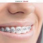 ortodoncia-dental-bracket-transparentes